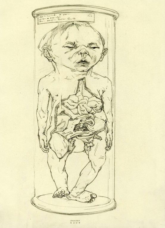 Foetus humain mâle éventré dans un bocal, musée Dupuytren, Paris