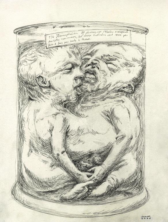 Foetus de siamois rattachés par le ventre dans un bocal, musée Dupuytren, Paris