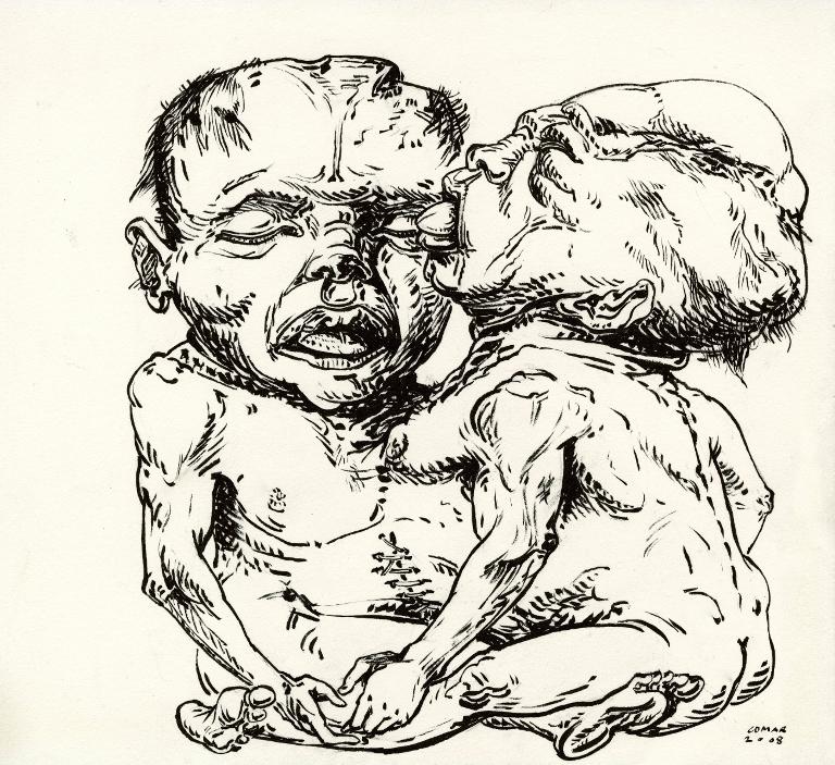 Foetus de siamois rattachés par le ventre (recousu), musée Dupuytren, Pari