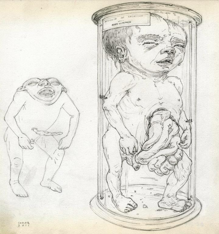 Foetus anencéphale et foetus mâle éventré dans un bocal, musée Dupuytren, Paris