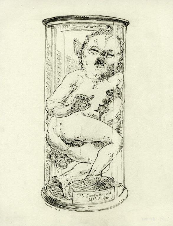 Foetus humain femelle (avec éventration abdominale) dans un bocal, musée Dupuytren,  Paris